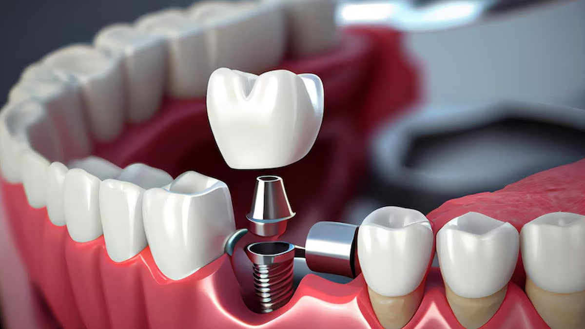 How To Care For Your Artificial Dental Crown And Improve Its Longevity?